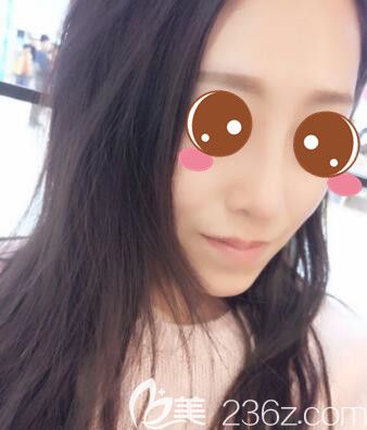 <!--<i data=20240703-sp></i>-->仁愛孫宇韓式小翹鼻+假體隆下巴真人案例術(shù)后30天 <!--<i data=20240703-sp></i>-->仁愛孫宇韓式小翹鼻+假體隆下巴真人案例術(shù)后30天