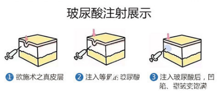 玻尿酸注射流程 玻尿酸注射流程