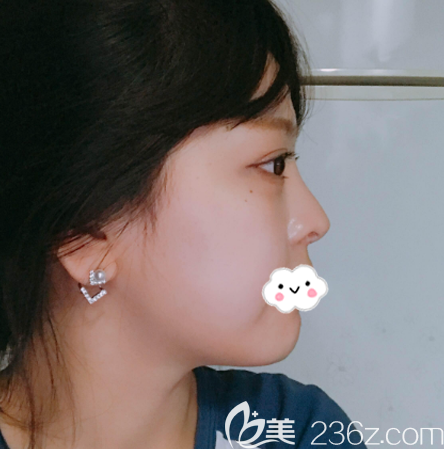 在韓國原辰整形醫(yī)院做雙眼皮隆鼻術(shù)前照片 在韓國原辰整形醫(yī)院做雙眼皮隆鼻術(shù)前照片