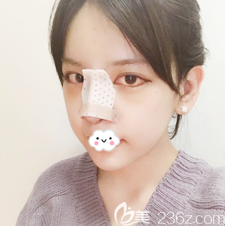 雙眼皮隆鼻和脂肪填充術(shù)后3天恢復(fù)過程圖 雙眼皮隆鼻和脂肪填充術(shù)后3天恢復(fù)過程圖