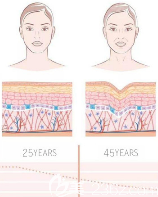 熱瑪吉作用皮膚的示意圖