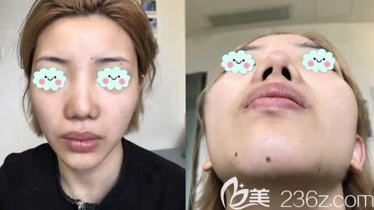 前一次做隆鼻失敗后的照片 前一次做隆鼻失敗后的照片