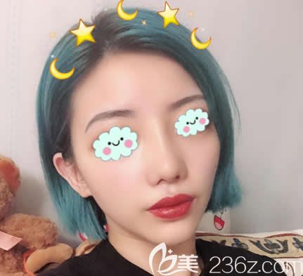 臺(tái)州藝星王波隆鼻失敗修復(fù)案例 臺(tái)州藝星王波隆鼻失敗修復(fù)案例