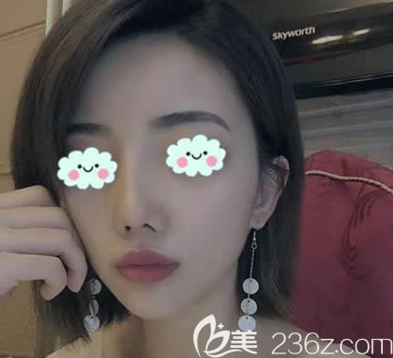 真實(shí)紀(jì)錄,還原我在臺州yestar藝星做隆鼻失敗后成功修復(fù)的過程及恢復(fù)效果,感謝王波主任