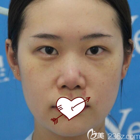 找耿繼龍做肋軟骨鼻綜合前樣子 找耿繼龍做肋軟骨鼻綜合前樣子