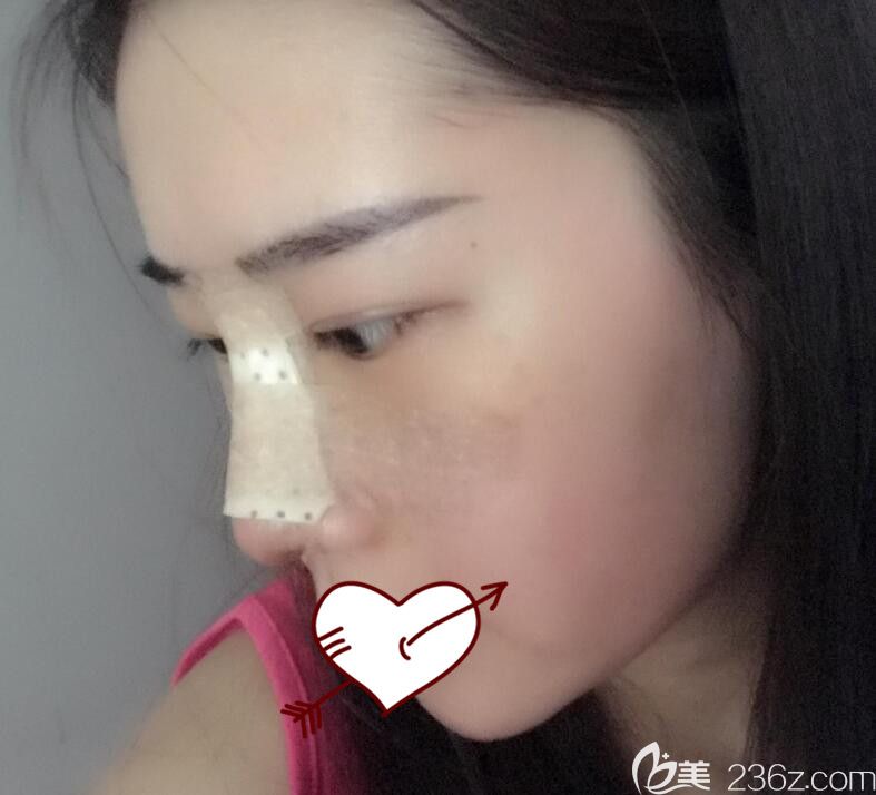 合肥藝星整形軟骨隆鼻第3天圖 合肥藝星整形軟骨隆鼻第3天圖