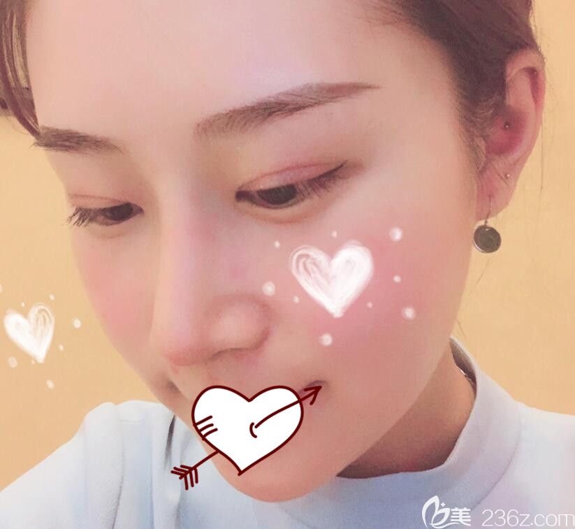 藝星整形肋軟骨隆鼻術后13天恢復情況 藝星整形肋軟骨隆鼻術后13天恢復情況