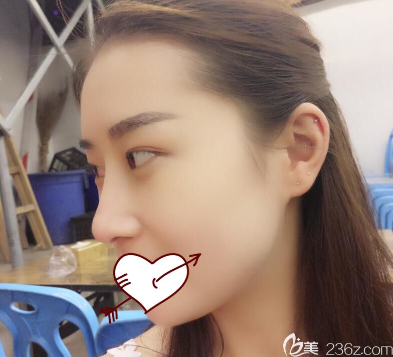 肋軟骨鼻綜合術后40天 肋軟骨鼻綜合術后40天