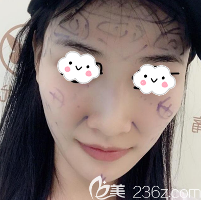 在深圳非凡做脂肪填充術(shù)前照片 在深圳非凡做脂肪填充術(shù)前照片