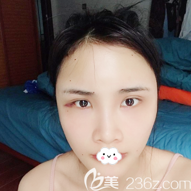 全臉自體脂肪填充術(shù)后4天恢復(fù)圖片 全臉自體脂肪填充術(shù)后4天恢復(fù)圖片