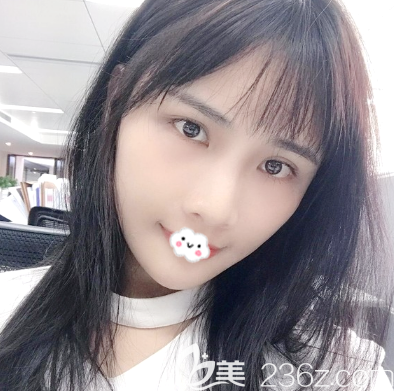 看深圳非凡全臉脂肪填充案例術(shù)后15天效果怎么樣 看深圳非凡全臉脂肪填充案例術(shù)后15天效果怎么樣