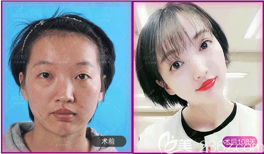 北京美萊葉宇醫(yī)生眼綜合案例