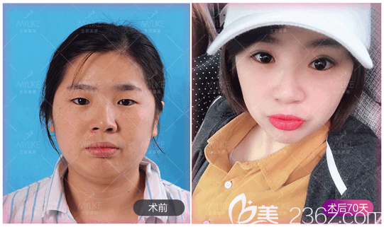 北京美萊李燕切開雙眼皮案例