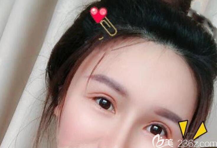 找合肥藝星整形孫洋做眼部修復(fù)第8天拆線后照片