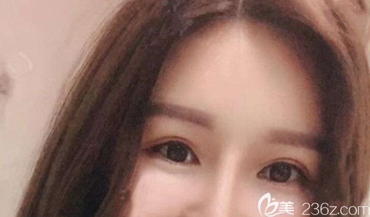 全切雙眼皮失敗修復(fù)第54天恢復(fù)情況