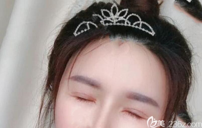 孫洋做眼部修復(fù)手術(shù)第8天閉眼照片