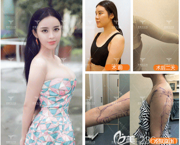 北京潤(rùn)美玉之光王明利雙上臂吸脂+脂肪隆胸實(shí)例