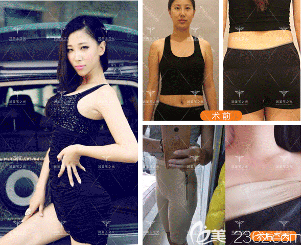 北京潤(rùn)美玉之光王明利腰腹和下巴吸脂實(shí)例