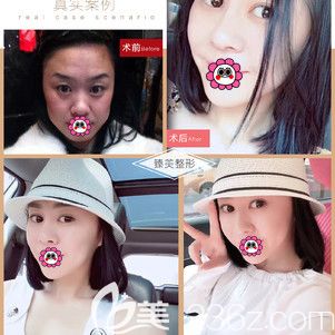 哈爾濱臻美雙眼皮案例