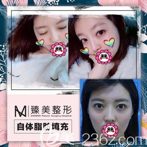 哈爾濱臻美自體脂肪填充面部效果圖