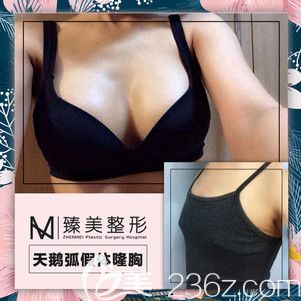 哈爾濱臻美天鵝弧隆胸對比效果