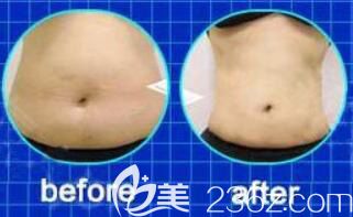 哈爾濱臻美吸脂瘦腰腹效果對比圖