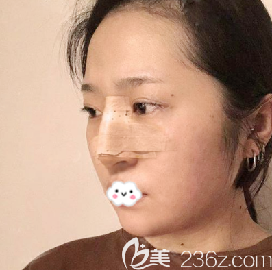 深圳美萊鼻翼縮小案例術(shù)后兩天效果圖 深圳美萊鼻翼縮小案例術(shù)后兩天效果圖