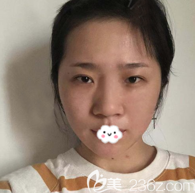 在深圳美萊做鼻翼縮小術(shù)前照片 在深圳美萊做鼻翼縮小術(shù)前照片