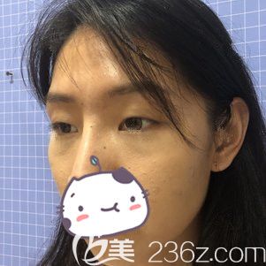 面診蘇州康美醫(yī)生術(shù)前單眼皮眼皮松弛下垂 面診蘇州康美醫(yī)生術(shù)前單眼皮眼皮松弛下垂