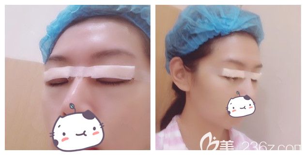 剛做完切開重瞼+上瞼下垂矯正 剛做完切開重瞼+上瞼下垂矯正