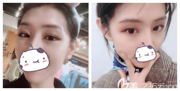 總以為眼綜合是雙眼皮+開(kāi)眼角，面診了蘇州康美才知道00后的自己更適合切開(kāi)重瞼+上瞼下垂矯正