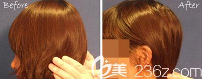 韓國bonps整形外科后腦勺填充照片