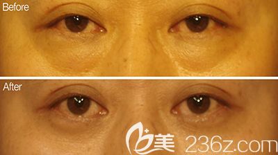 韓國bonps整形外科眼底整形照片