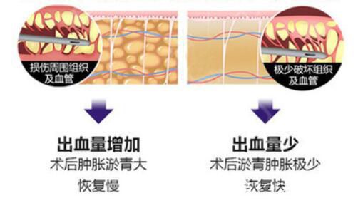 面部吸脂多久可以消腫
