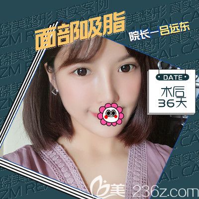 哈爾濱臻美面部吸脂術(shù)后恢復(fù)36天