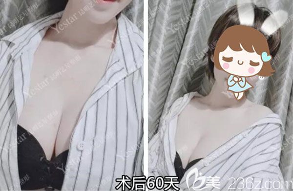 談?wù)勎以诶ッ魉囆钦倚焱鳆湼窦袤w豐胸295CC真實(shí)感受及術(shù)后恢復(fù)效果