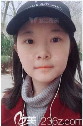 我在北京紫潔做眼綜合第25天效果 我在北京紫潔做眼綜合第25天效果