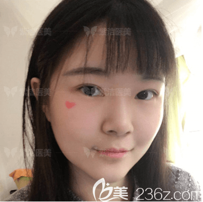 我在北京紫潔醫(yī)美找劉文峰做的眼綜合手術(shù)不止20天恢復(fù)圖呈現(xiàn)給你