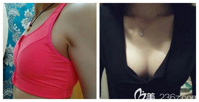 聊城韓美整形自體脂肪隆胸案例