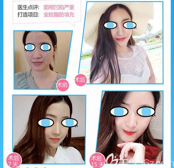 聊城韓美整形全臉自體脂肪填充案例