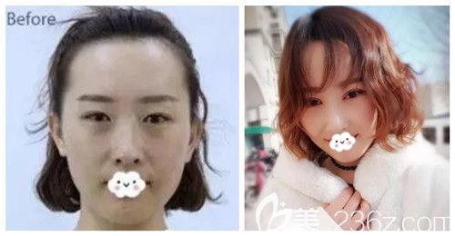 唐山蘇亞美聯(lián)臣做雙眼皮案例 唐山蘇亞美聯(lián)臣做雙眼皮案例