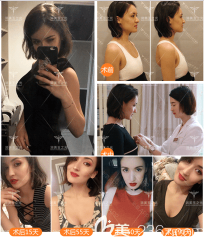 北京潤美玉之光王明利醫(yī)生αPRP+JET純化脂肪隆胸真實(shí)案例