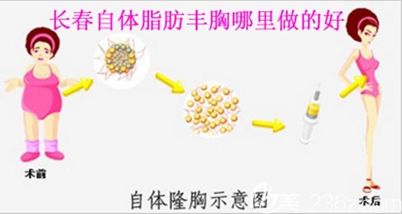 長(zhǎng)春自體脂肪豐胸哪里做的好