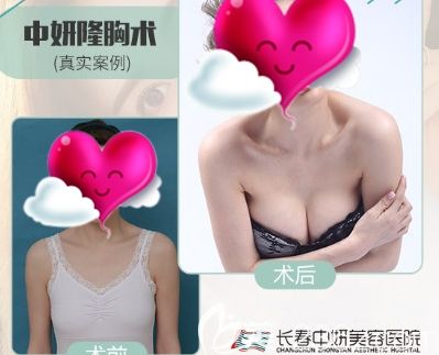 長(zhǎng)春中妍整形趙勝有醫(yī)生自體脂肪豐胸效果