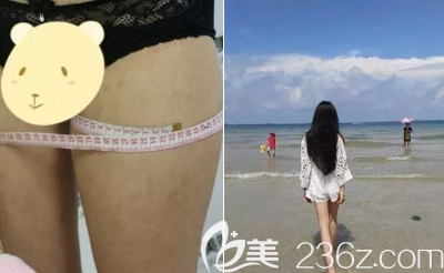 大腿吸脂案例