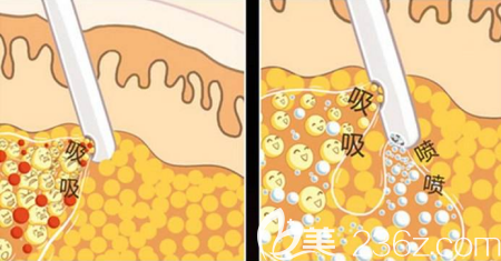 吸脂示意圖
