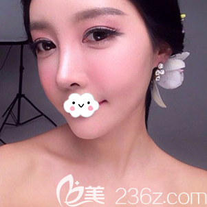 找韓國普羅菲耳（profile）整形醫(yī)院李好基做了鼻綜合和假體豐下巴，好多人都說自然好看