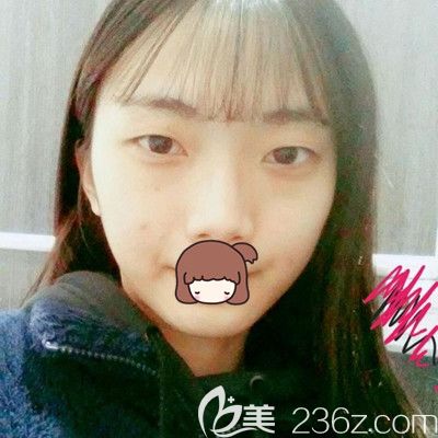 在韓國純真做眼鼻綜合手術前 在韓國純真做眼鼻綜合手術前