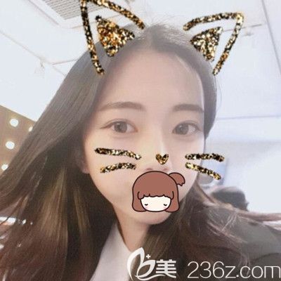 在韓國純真做眼鼻綜合手術后1個月 在韓國純真做眼鼻綜合手術后1個月