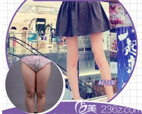 羅安定大腿吸脂前后效果對(duì)比圖 羅安定大腿吸脂前后效果對(duì)比圖